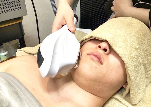 光フェイシャル